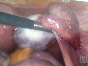 Right ovary and tube, it looks like there might be some endo on the tube